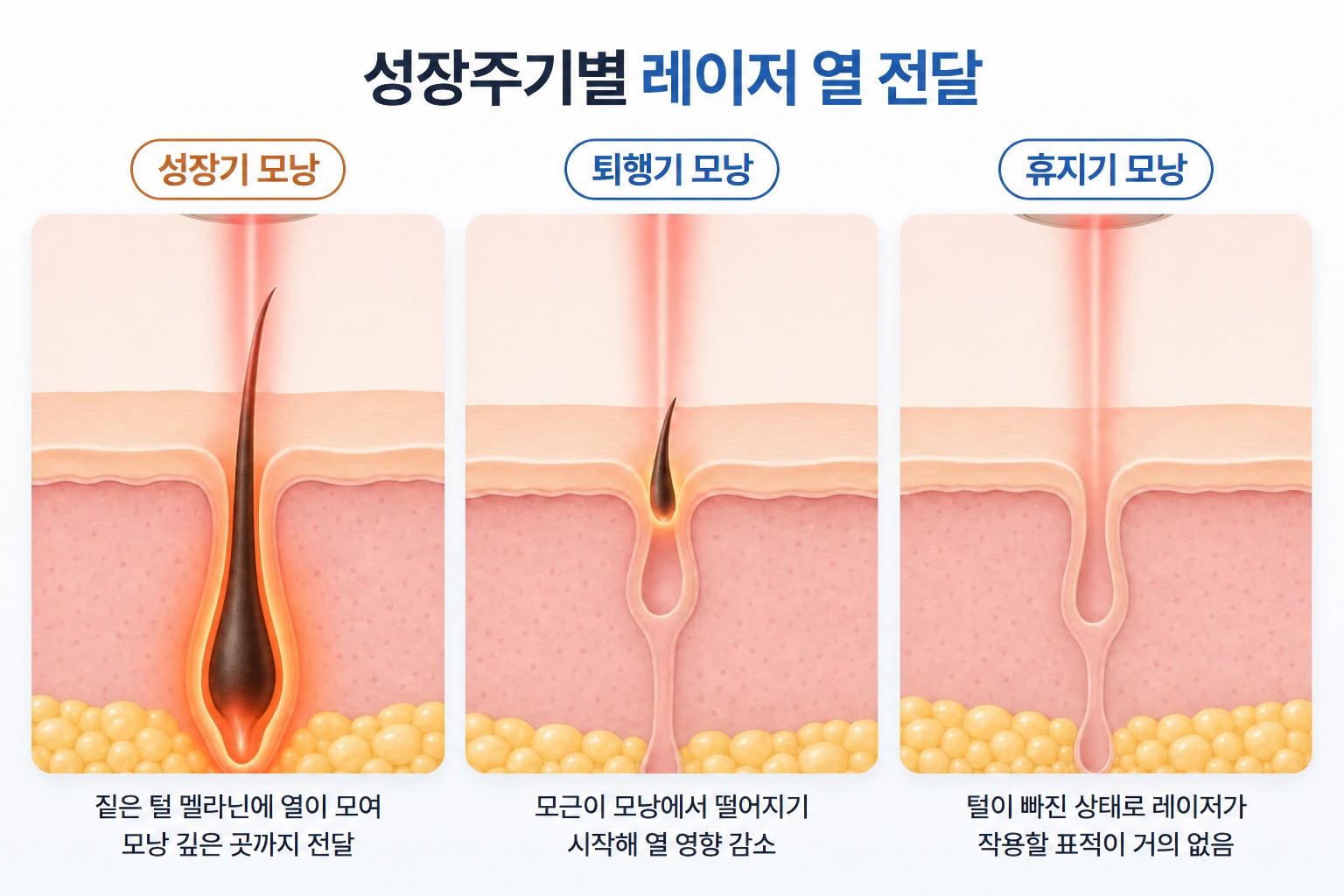 성장기 모낭에는 레이저 열이 깊이 전달되고 퇴행기와 휴지기에는 반응이 제한적인 피부 단면 비교