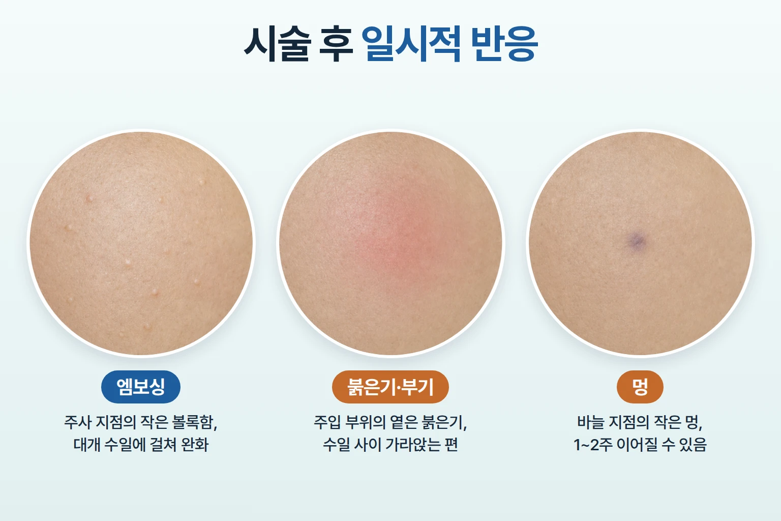 엘라비에 리투오 시술 후 나타날 수 있는 주사 부위의 작은 엠보싱, 붉은기와 부기, 점 모양 멍의 피부 상태 비교