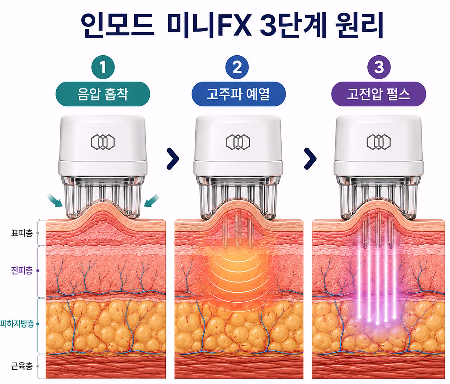 인모드 미니FX 3단계 원리 - 음압 고주파 예열 고전압 펄스