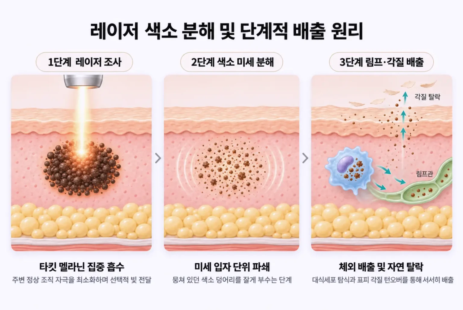 레이저 조사로 멜라닌을 미세 입자로 분해한 뒤 대식세포 탐식과 표피 각질 탈락으로 배출되는 3단계 원리 모식도