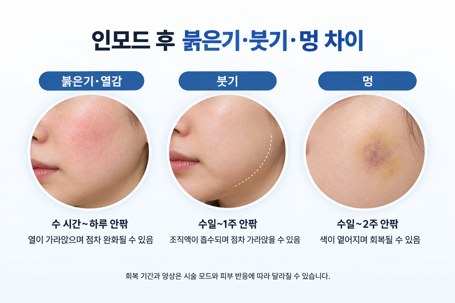 인모드 시술 후 볼의 붉은기와 턱선 붓기, 피부에 남은 옅은 멍의 차이와 증상별 회복 기간