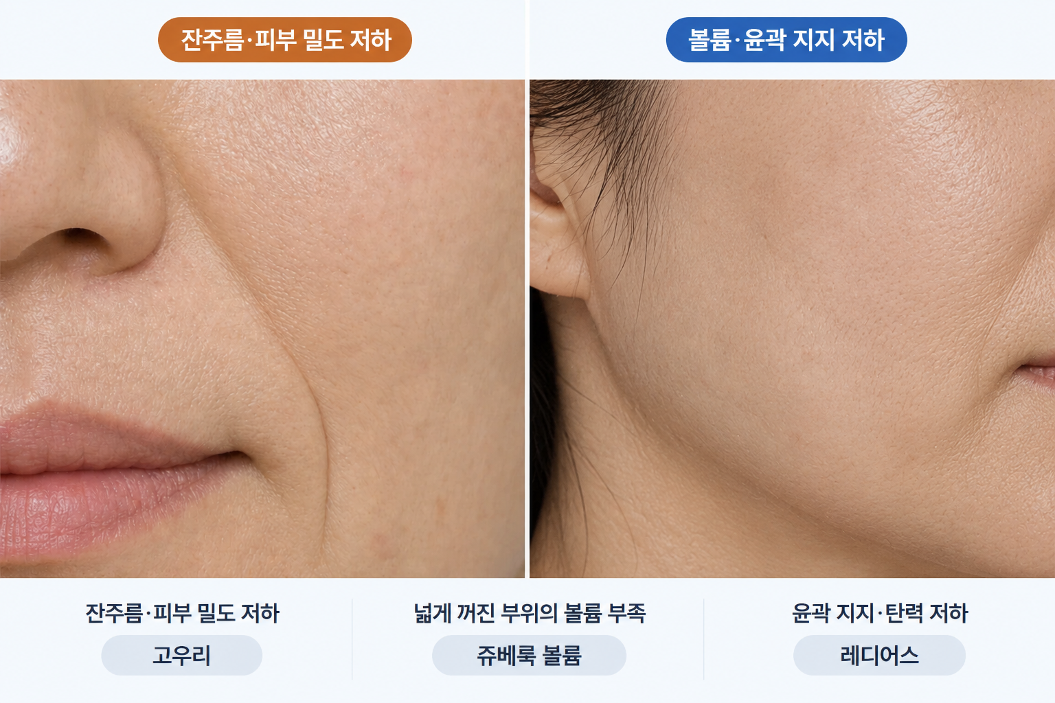 잔주름·피부 밀도 저하에는 고우리, 넓은 부위의 볼륨 부족에는 쥬베룩 볼륨, 윤곽 지지와 탄력 저하에는 레디어스를 고려하는 피부 고민별 콜라겐 주사 선택 기준