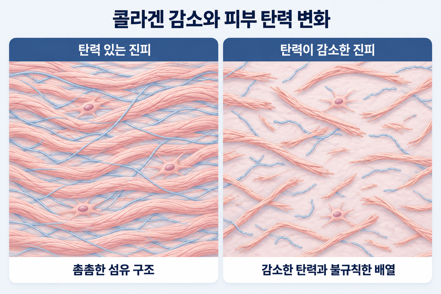 피부 탄력 저하에 따른 진피 속 콜라겐과 엘라스틴 섬유의 감소 및 배열 변화를 비교한 이미지