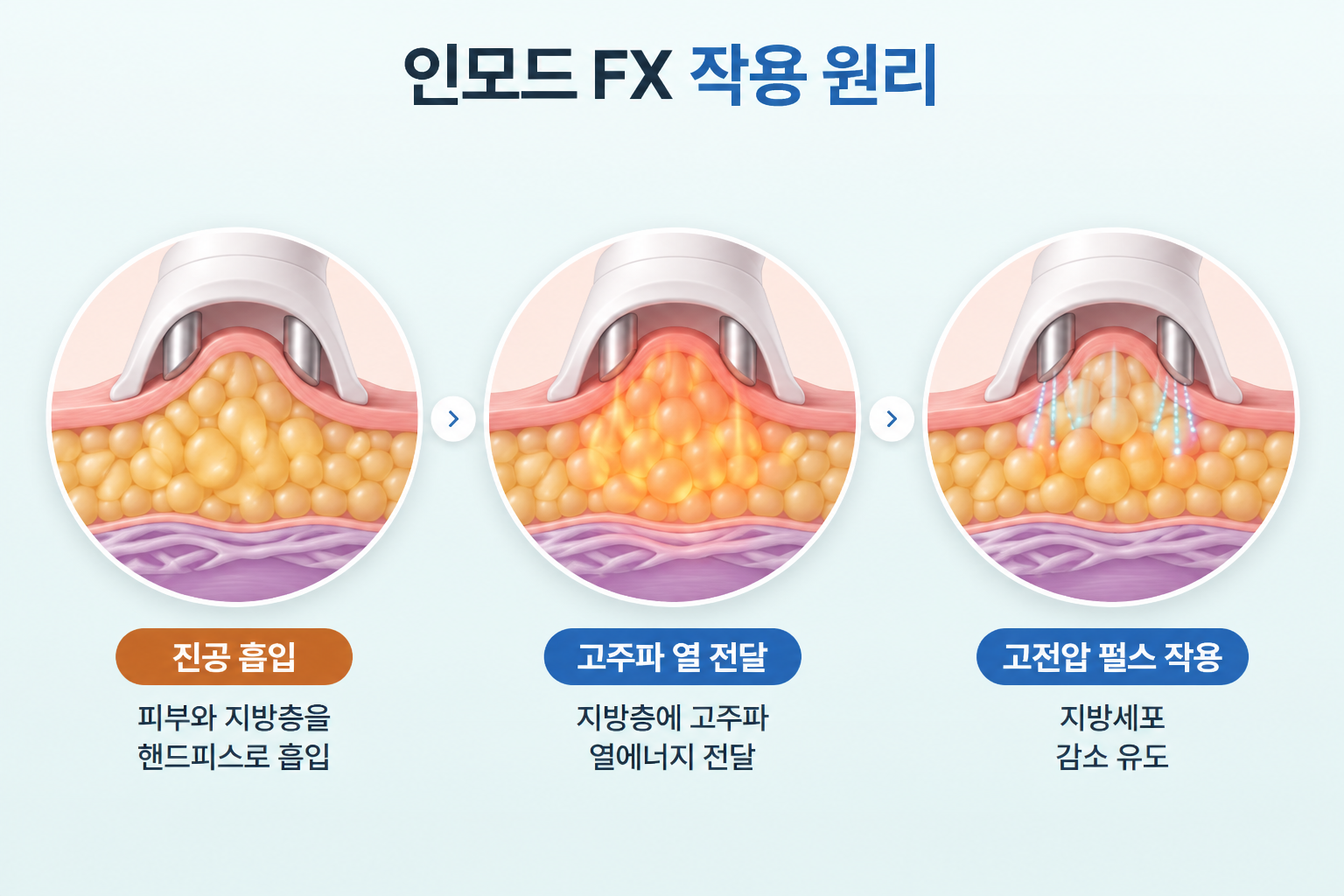 인모드 FX의 진공 흡입을 통한 피부와 지방층 밀착, 고주파 열에너지 전달, 고전압 펄스를 이용한 지방세포 감소 유도 과정
