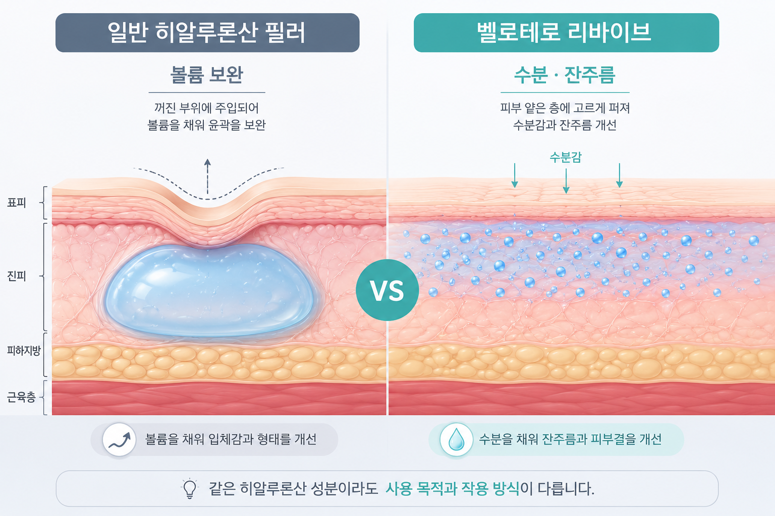 일반 히알루론산 필러의 볼륨 보완과 벨로테로 리바이브의 얕은 층 분포