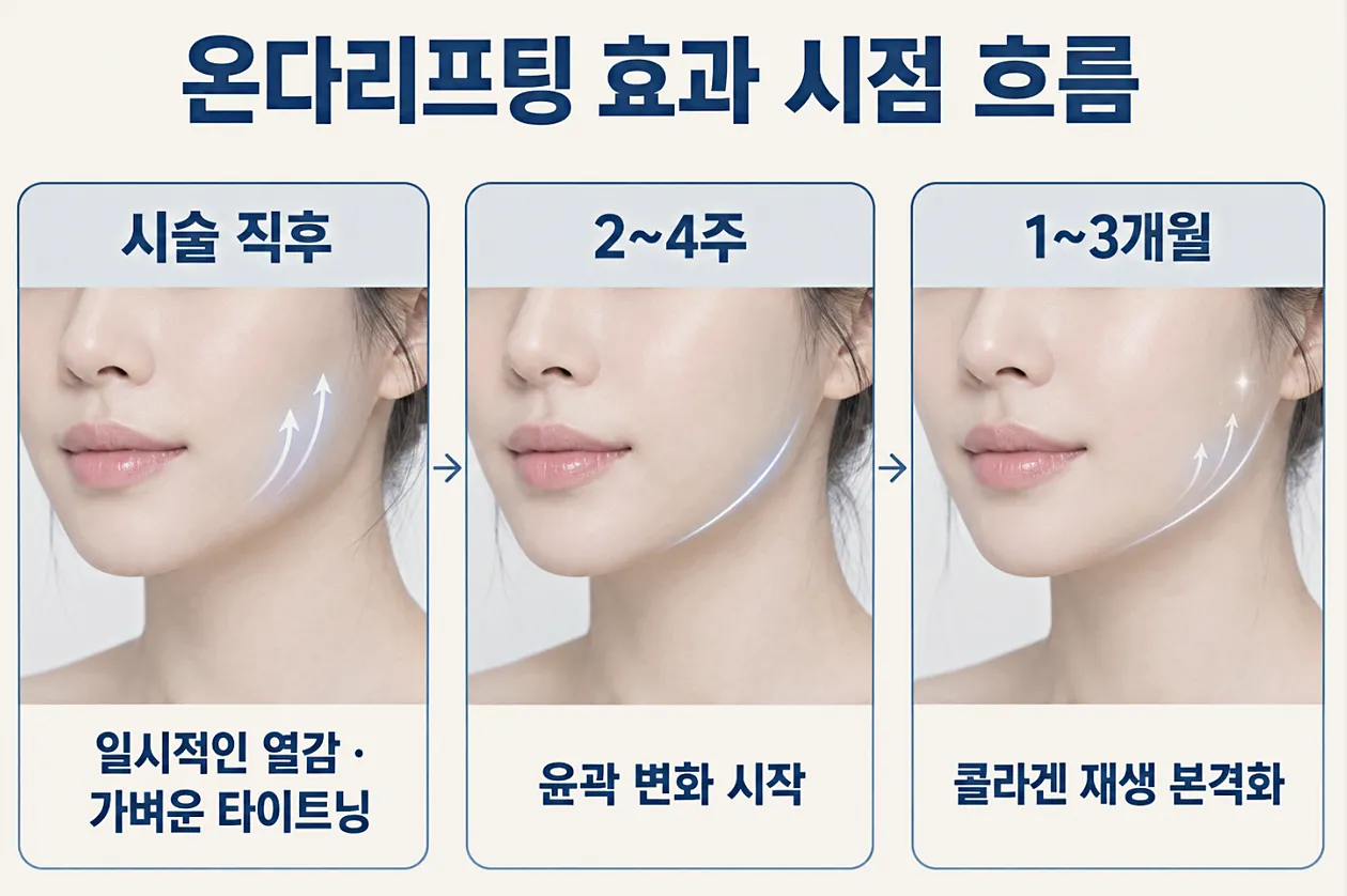 온다리프팅 효과 시점 흐름 - 시술 직후부터 유지 구간까지