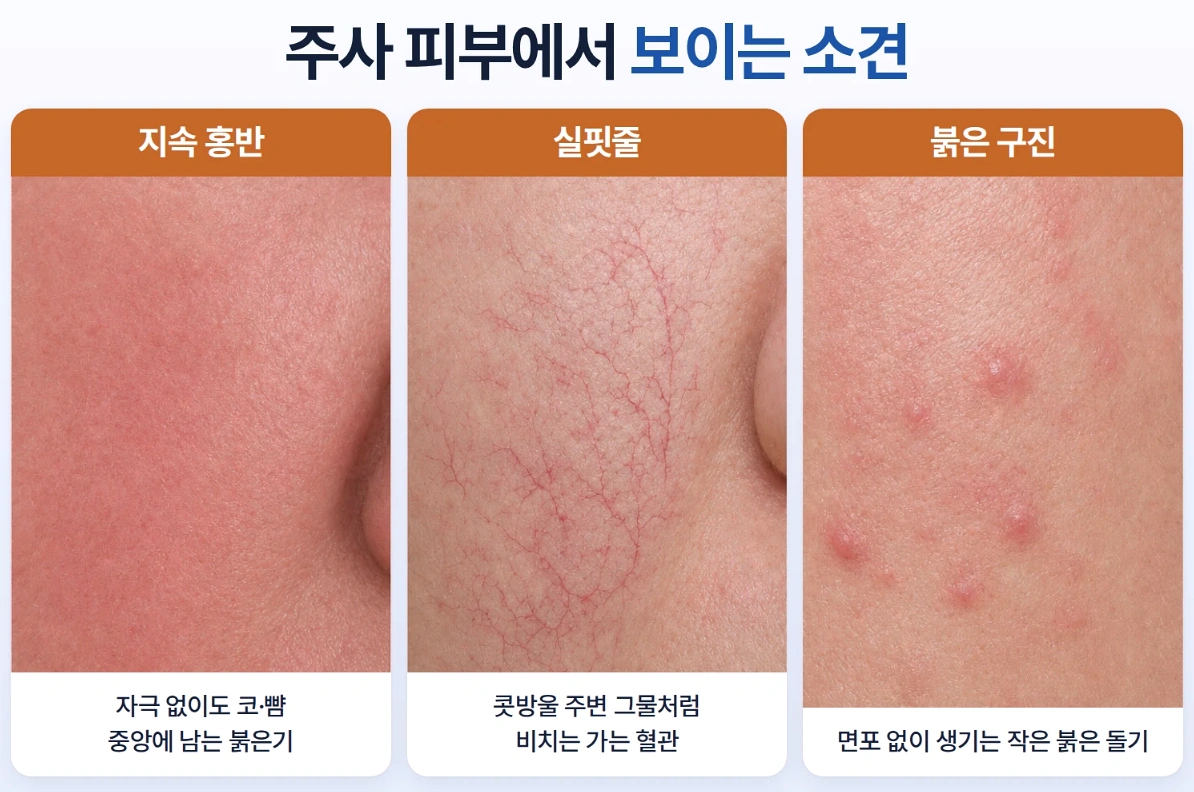 지속 홍반, 실핏줄, 붉은 구진의 특징을 피부 표면 확대 사진으로 비교한 주사 피부염 증상 인포그래픽