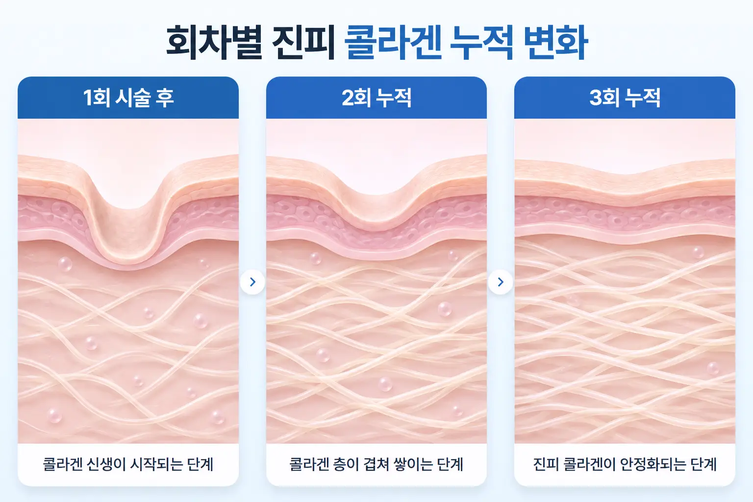 회차가 늘어날수록 진피 콜라겐 섬유가 겹쳐 쌓이는 변화를 동일 배율로 비교한 일러스트