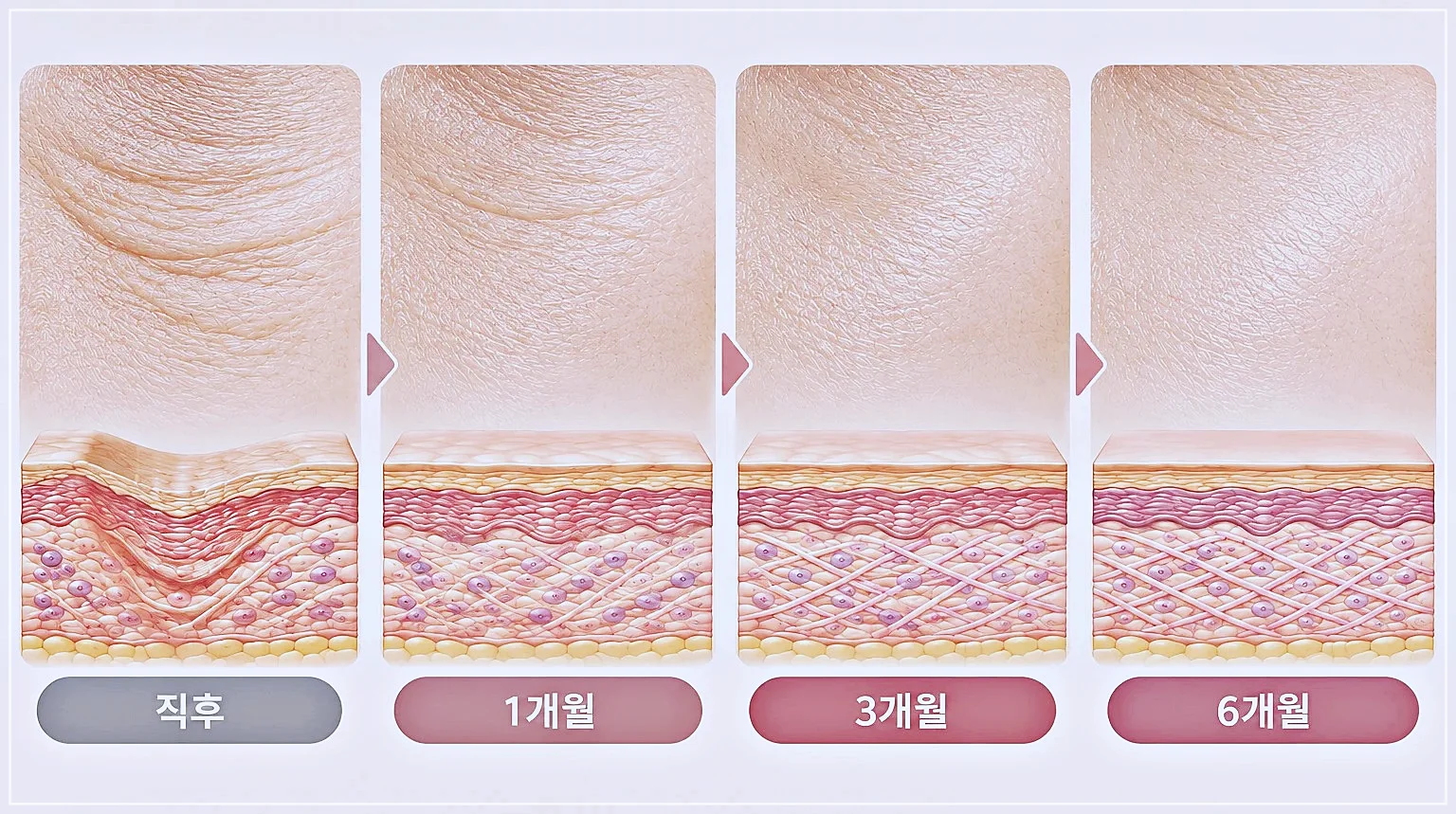 아이써마지 시점별 변화 흐름 - 직후부터 6개월까지