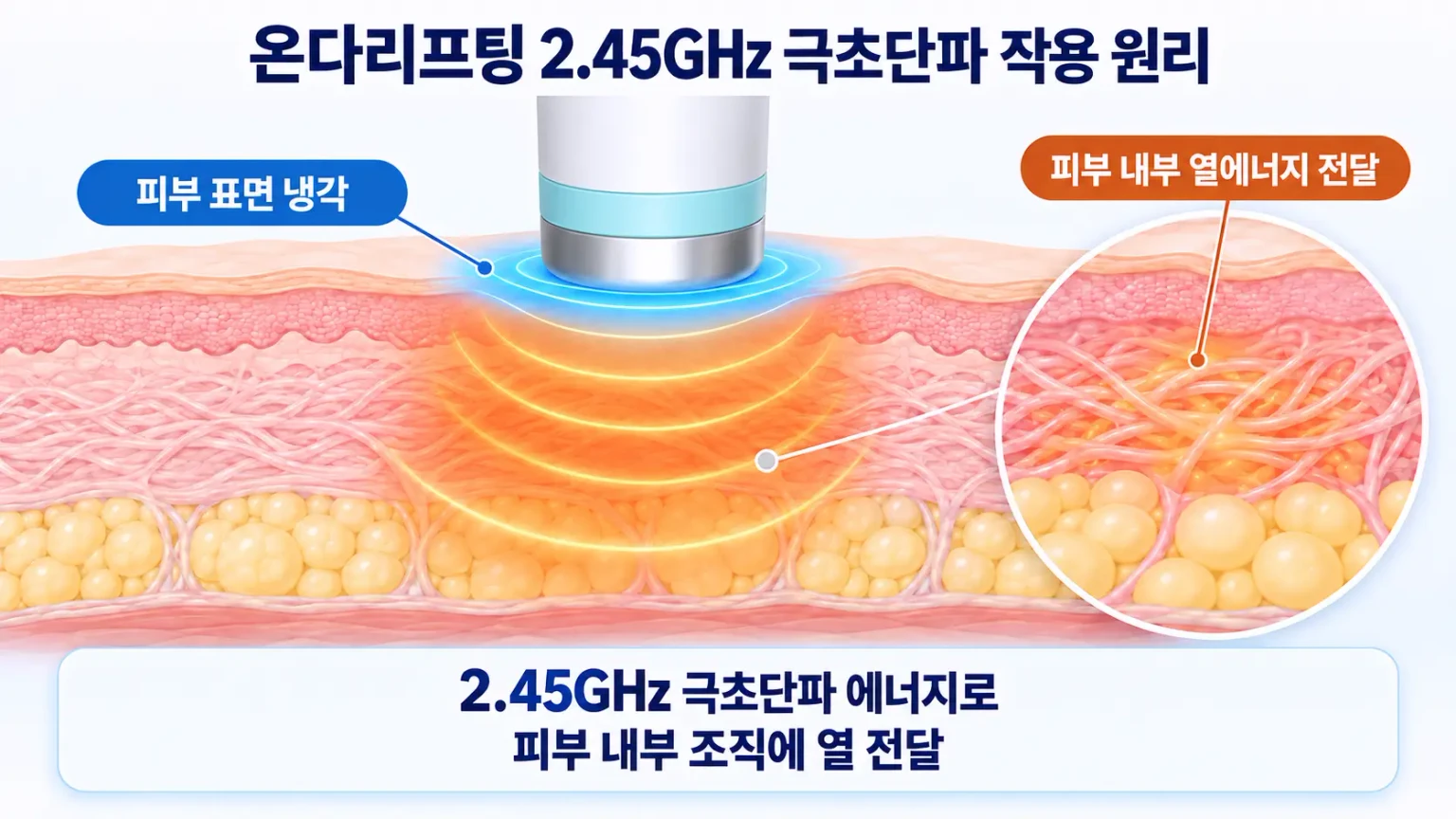 온다리프팅 2.45GHz 극초단파의 피부 표면 냉각 및 내부 열에너지 전달 원리