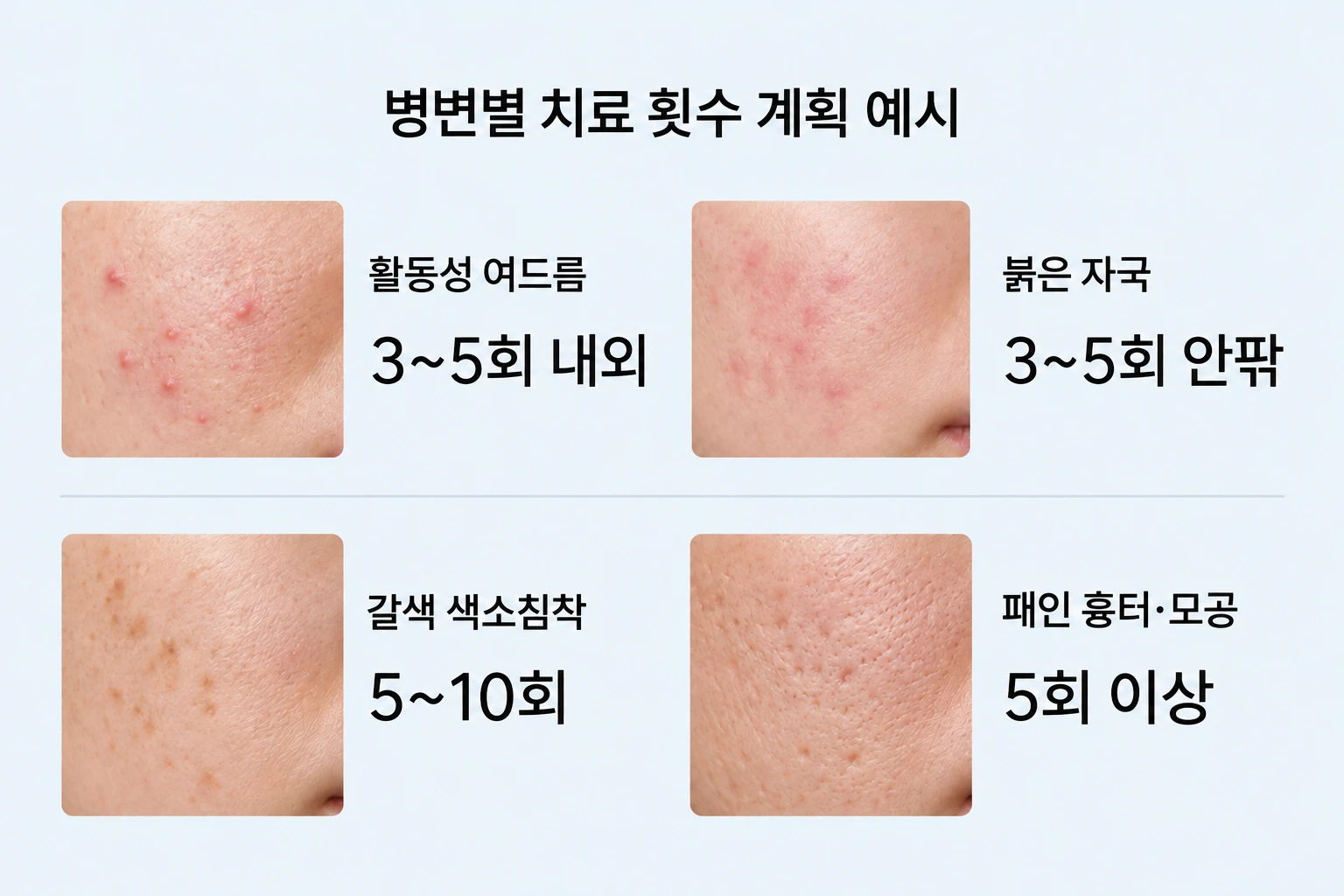 활동성 여드름과 붉은 자국·갈색 색소침착·패인 흉터의 치료 횟수 계획 비교