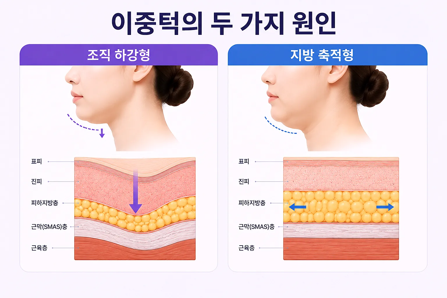 이중턱 원인 구분 - 조직 하강과 지방 축적의 차이