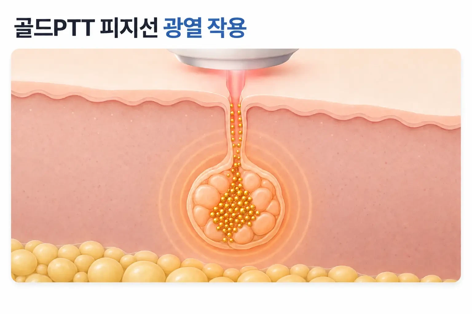 모공을 따라 들어간 금 입자가 피지선 주변에서 레이저 빛을 받아 열을 내는 피부 단면 일러스트