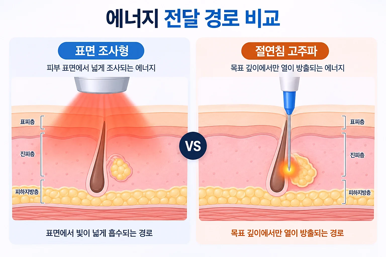 표면에서 넓게 퍼지는 빛과 침 끝에서만 나오는 열의 경로를 동일 배율로 비교한 단면 개념도