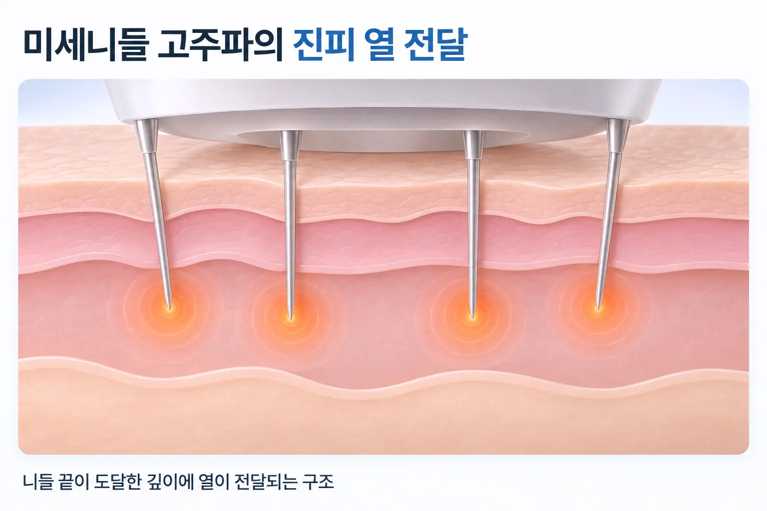 미세니들이 진피에 들어가 모공 주변으로 고주파 열이 퍼지는 과정을 나타낸 단면 개념도