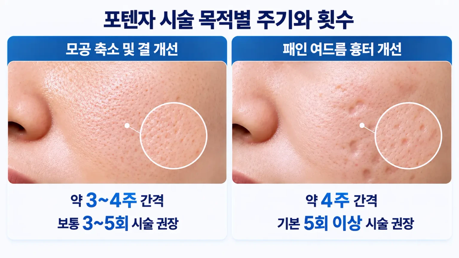 포텐자 모공 개선과 여드름 흉터 관리의 시술 주기 및 횟수 비교