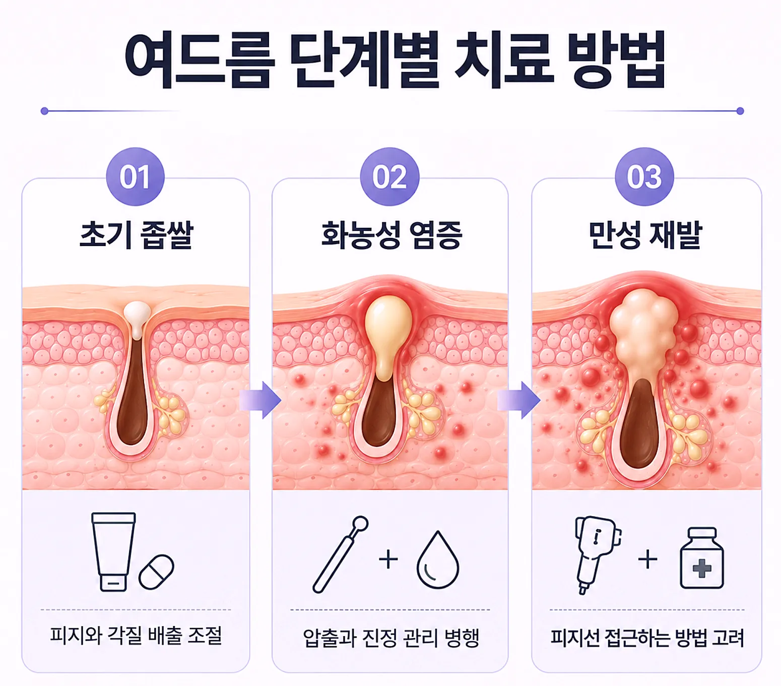 여드름 염증 단계별 치료 접근 - 초기 좁쌀 화농성 만성 재발