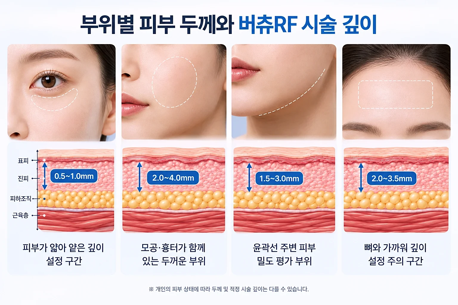 눈가, 볼, 턱선, 이마의 피부 두께 차이를 부위별로 비교한 시술 부위 크롭 사진