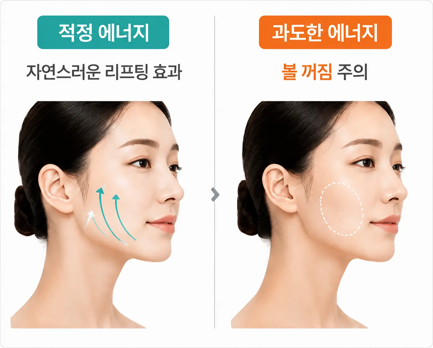 울쎄라 리프팅 시 에너지 조절이 중요한 이유