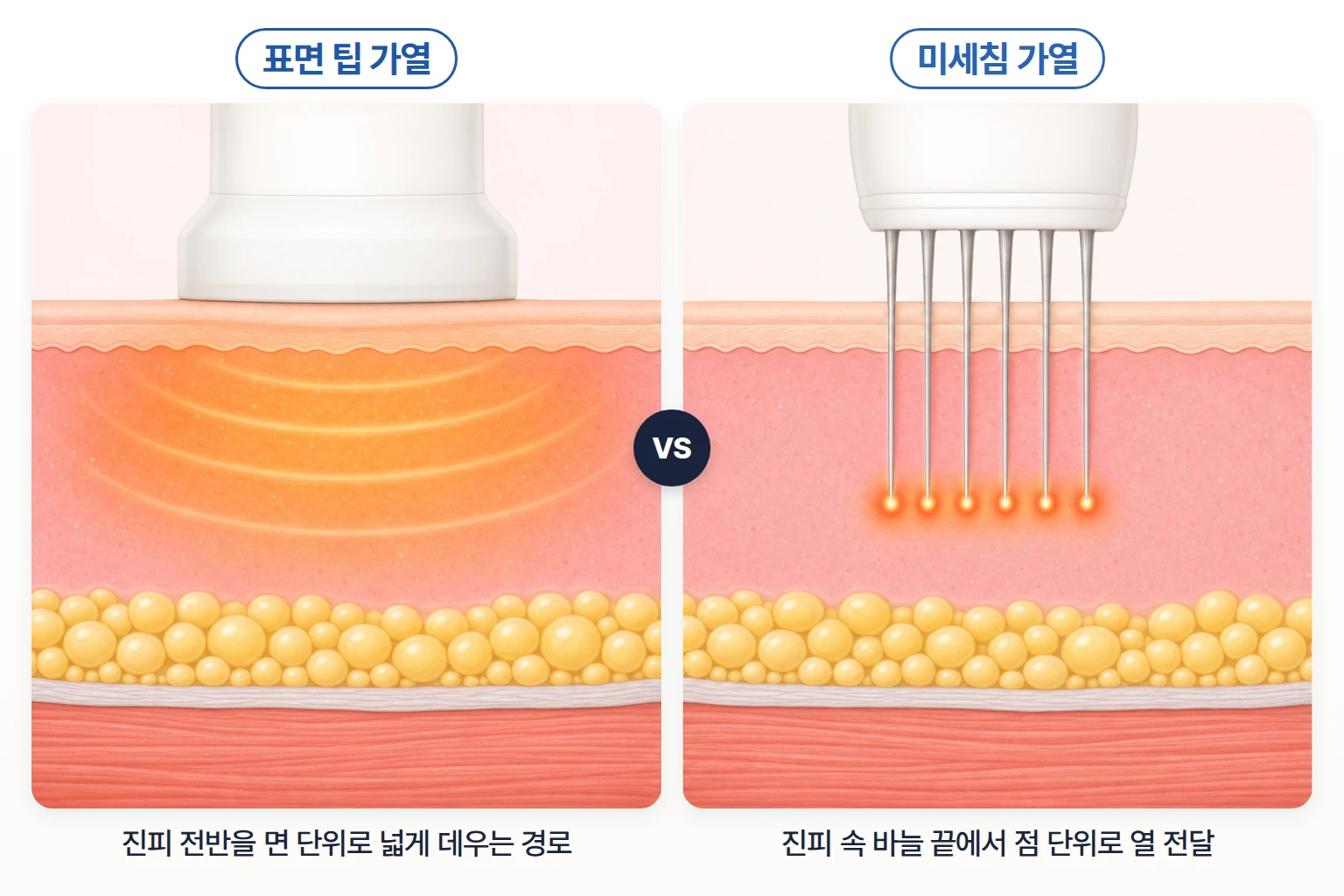 표면 팁 고주파와 미세침 고주파의 피부 열에너지 전달 방식 비교
