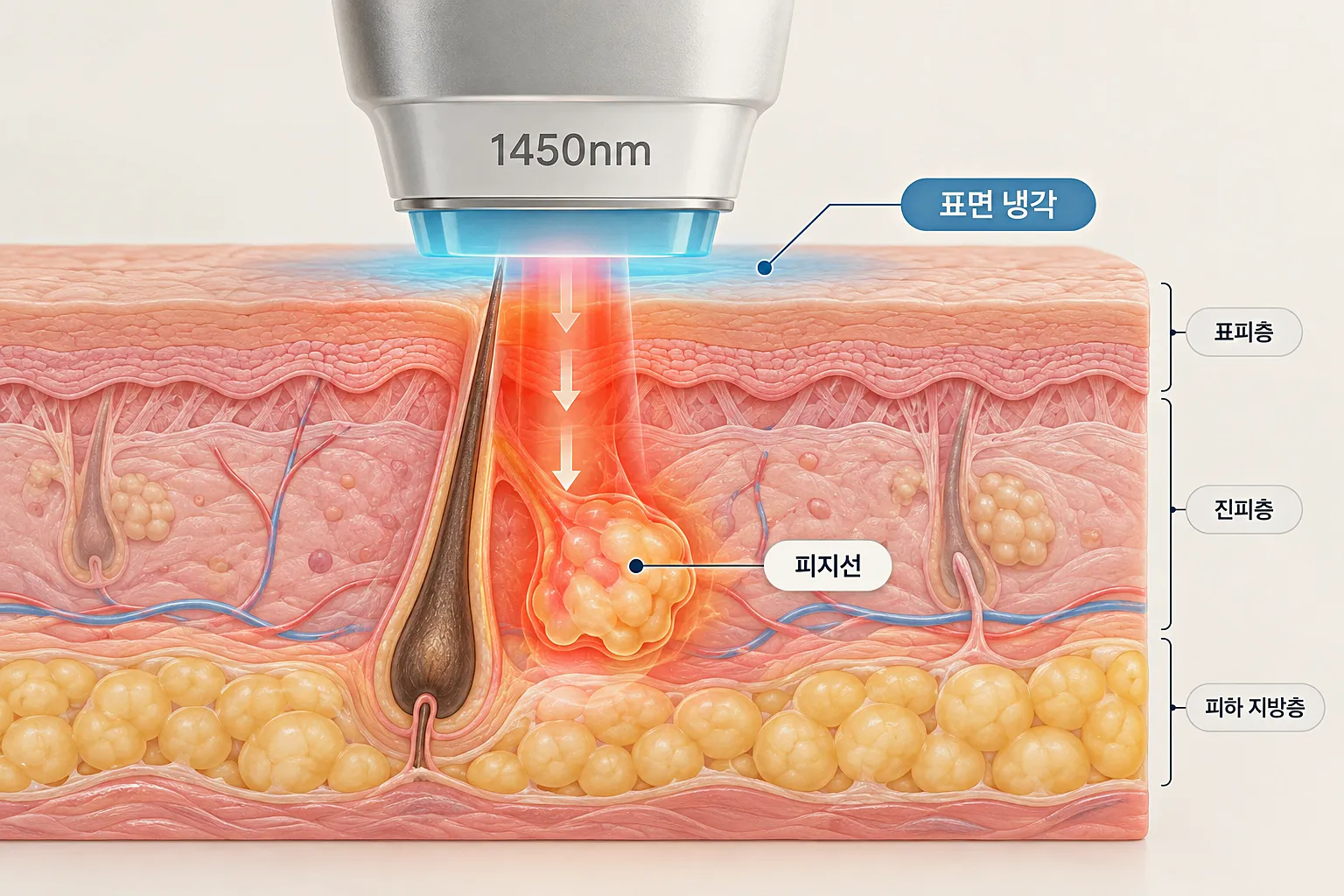 네오빔 1450nm 파장의 피지선 도달 구조