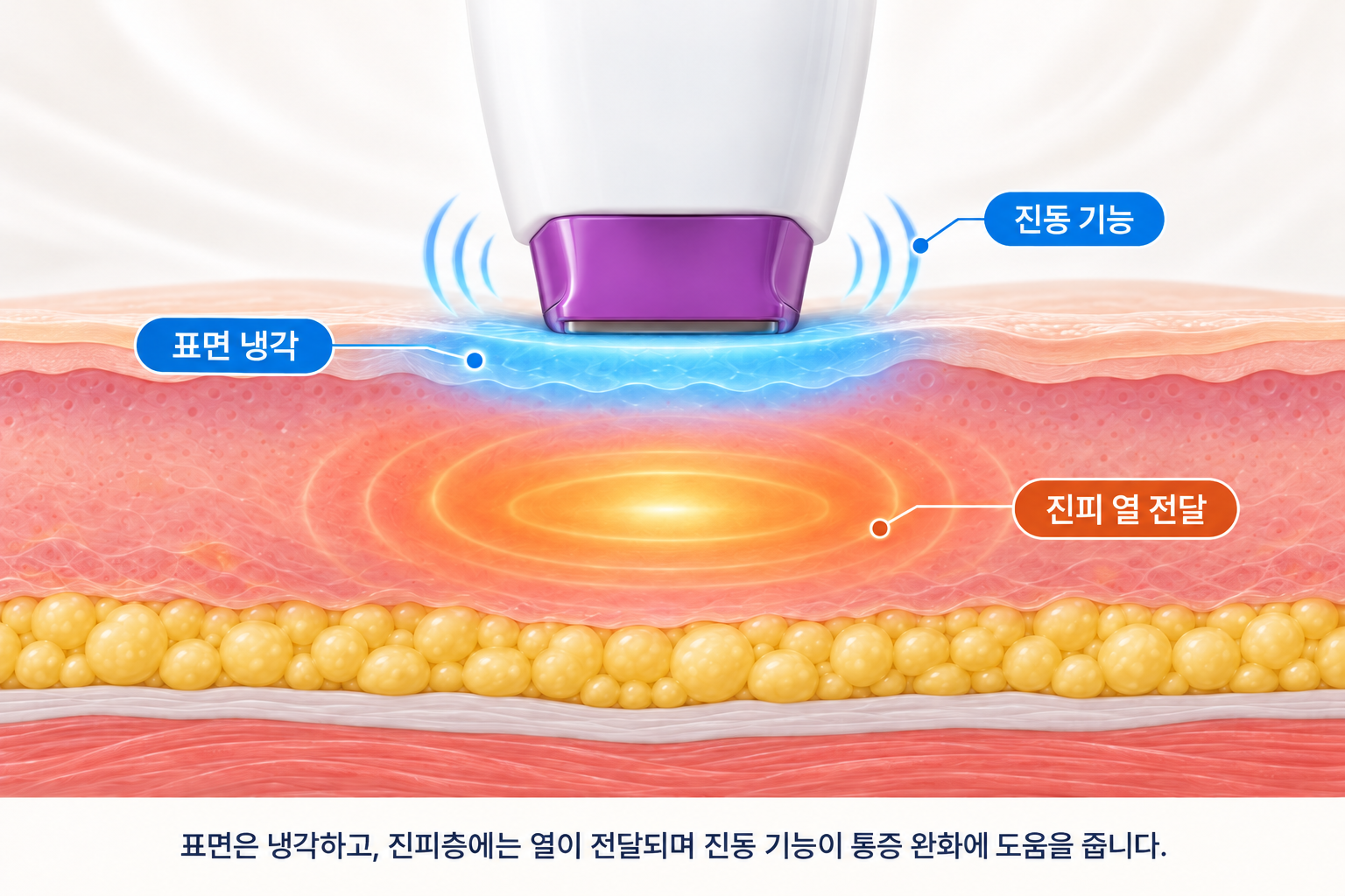 써마지 FLX 팁의 피부 표면 냉각과 진동 기능, 진피층 고주파 열 전달 구조