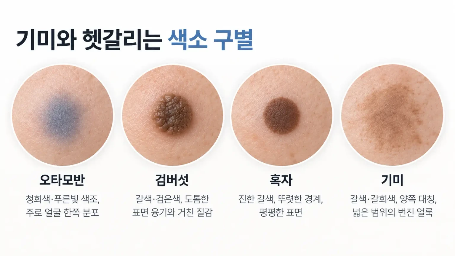 오타모반, 검버섯, 일광흑자, 기미의 색조와 경계, 표면 차이를 정리한 비교 카드 이미지