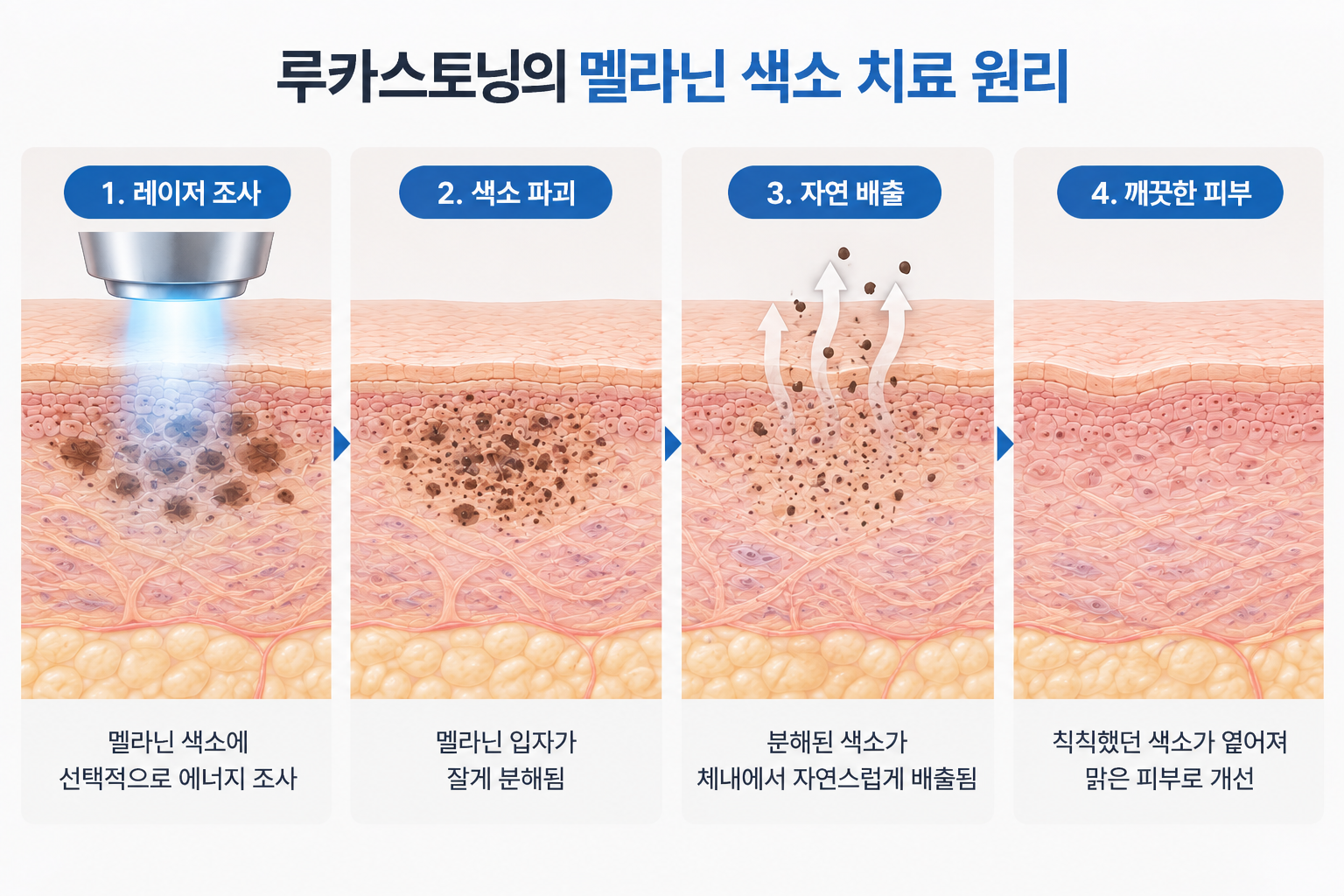 루카스토닝 멜라닌 색소 분해와 여드름 후 색소침착 치료 과정