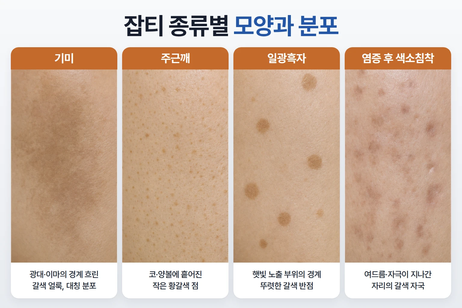 잡티 제거 레이저 전 구분할 기미의 넓은 갈색 얼룩, 주근깨의 작은 점, 일광흑자의 뚜렷한 반점, 염증 후 색소침착의 갈색 자국