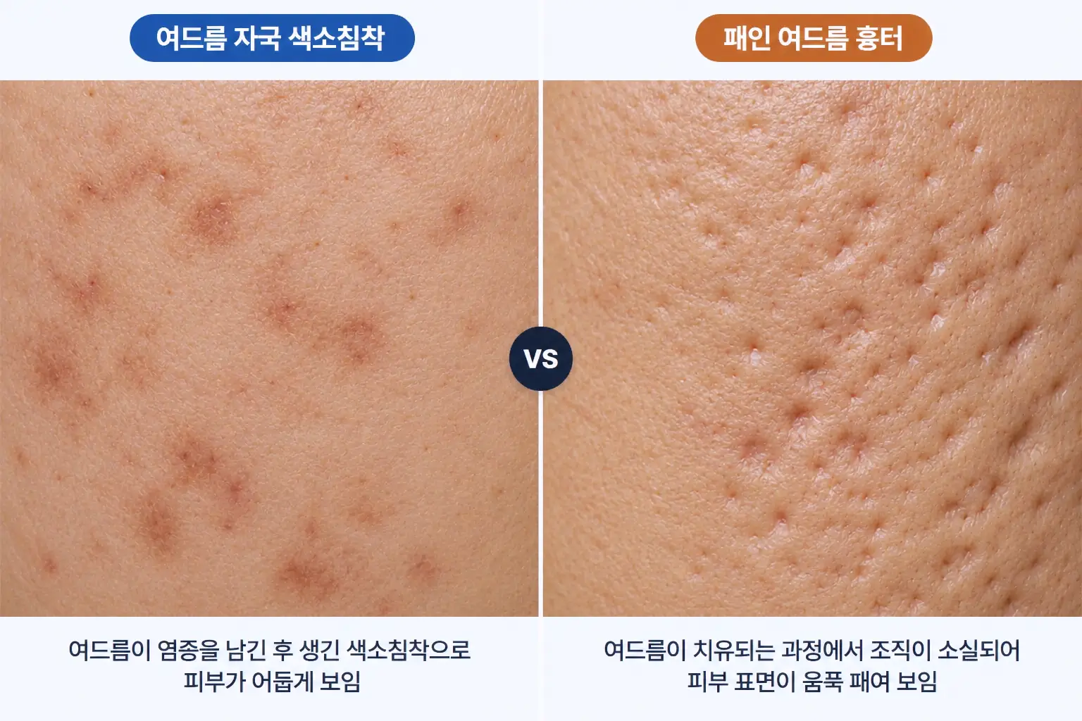 여드름 자국의 색 변화와 표면이 패인 흉터를 같은 배율로 비교한 피부 표면 확대 사진