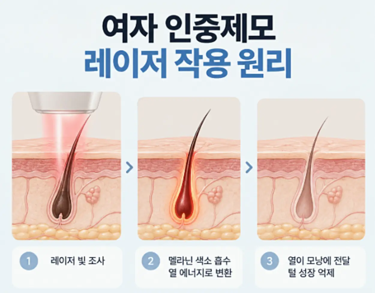 여자 인중제모 레이저 빛이 털의 멜라닌 색소에 흡수되어 열에너지로 변하고, 모낭에 열을 전달해 털의 성장을 억제하는 과정을 나타낸 피부 단면 일러스트