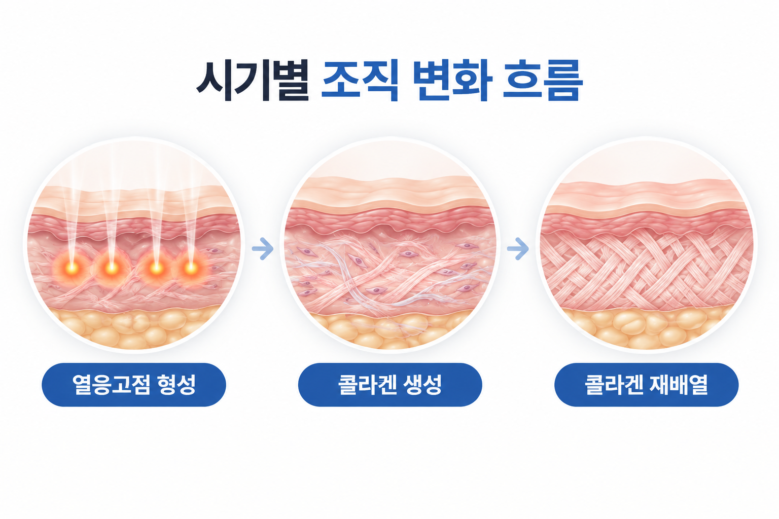열응고점 형성 후 콜라겐 생성과 재배열로 이어지는 조직 변화 흐름