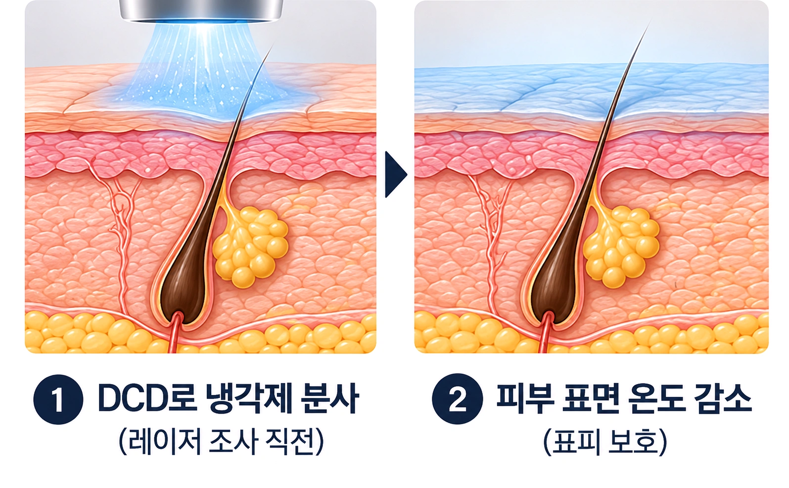 레이저 조사 전 피부 표면을 냉각해 보호하는 네오빔 레이저 냉각 원리