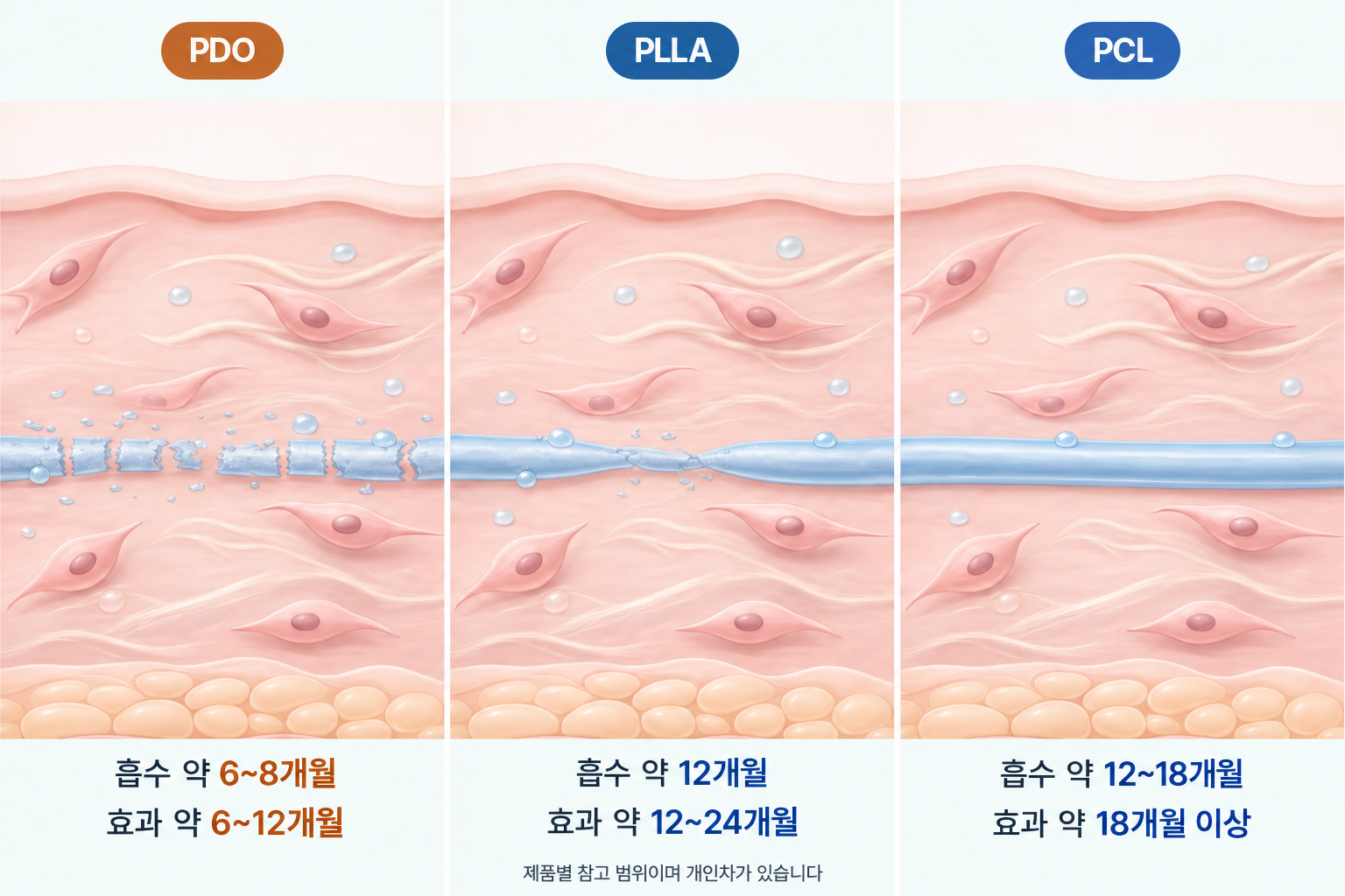 PDO·PLLA·PCL 녹는 실의 분해 상태와 소재별 체내 흡수기간 및 리프팅 효과 유지기간 차이