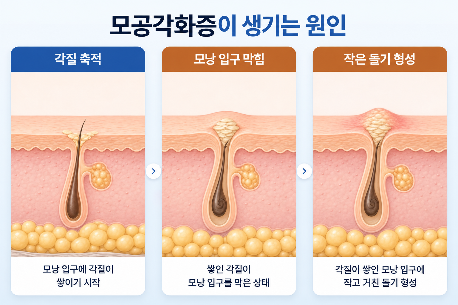 모낭 입구에 각질이 쌓여 입구를 막고 작은 돌기가 형성되는 과정