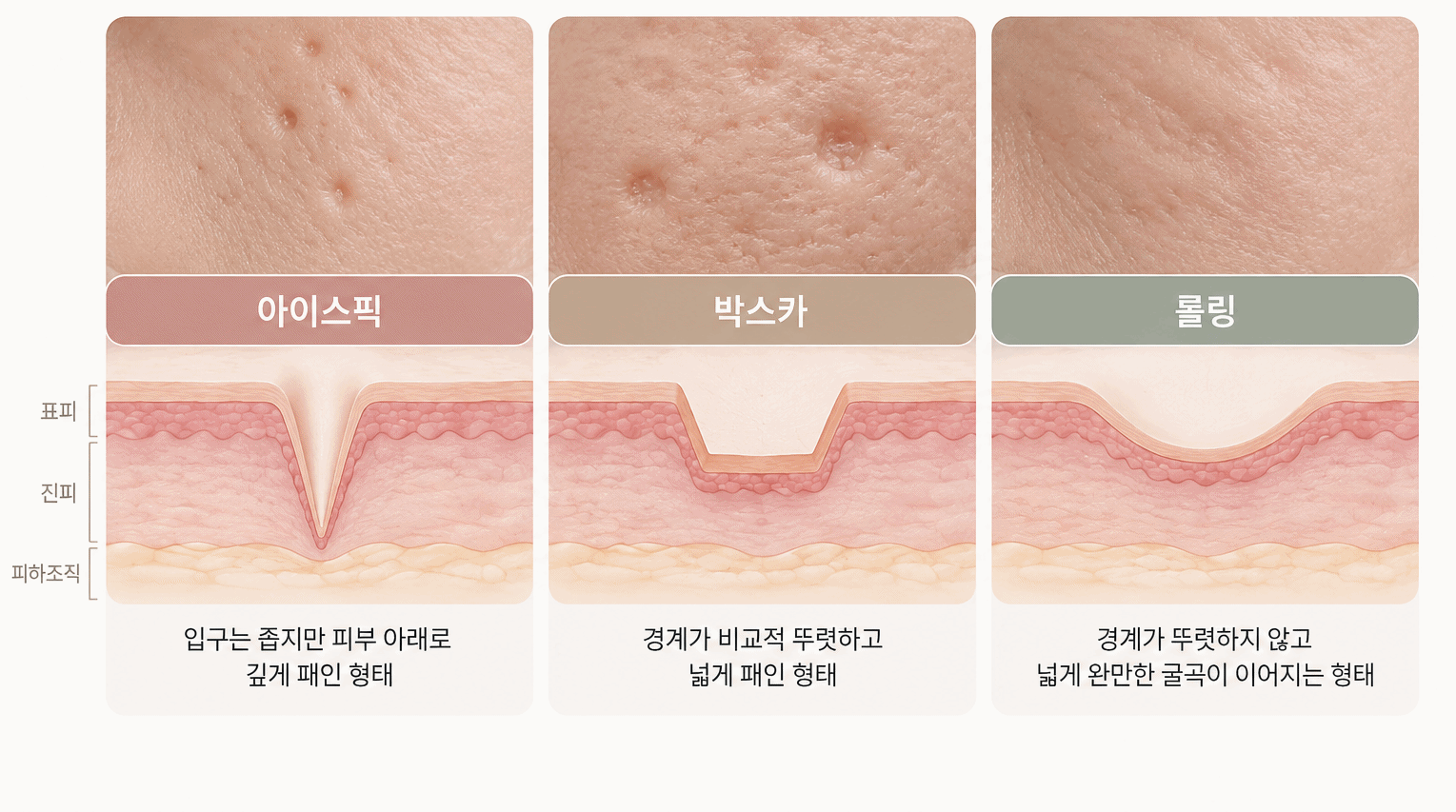 아이스픽, 박스카, 롤링 여드름흉터의 모양과 깊이 차이