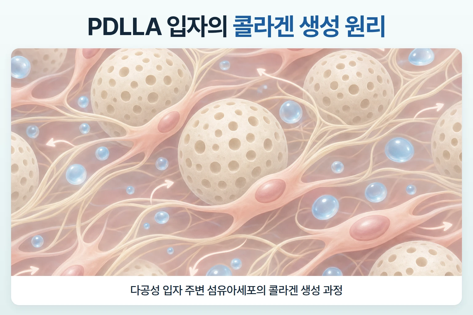 다공성 PDLLA 입자와 섬유아세포 주변에서 새 콜라겐이 형성되는 과정을 확대한 개념도