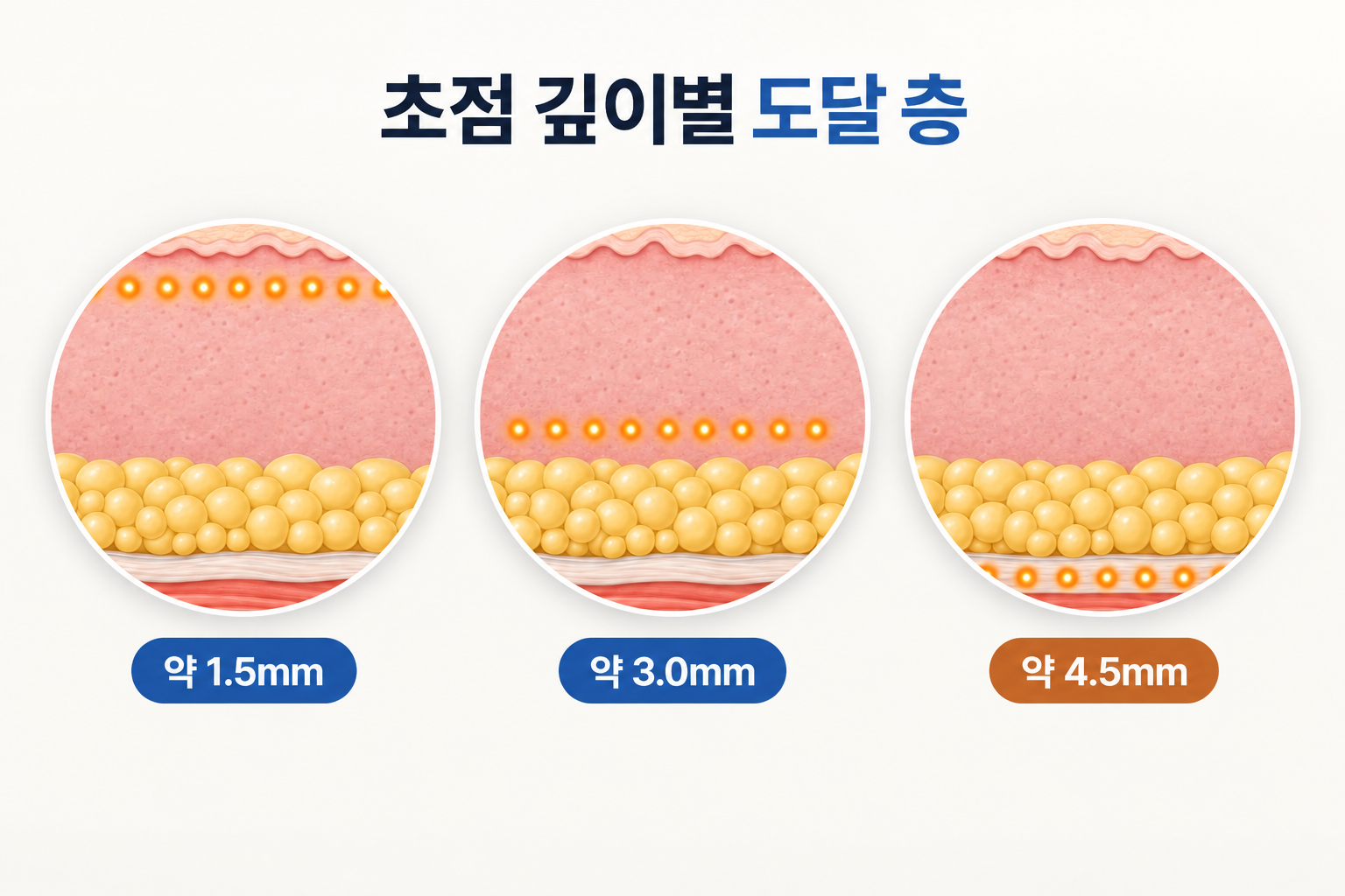 초음파 리프팅 1점5밀리미터 3점0밀리미터 4점5밀리미터 도달층 비교