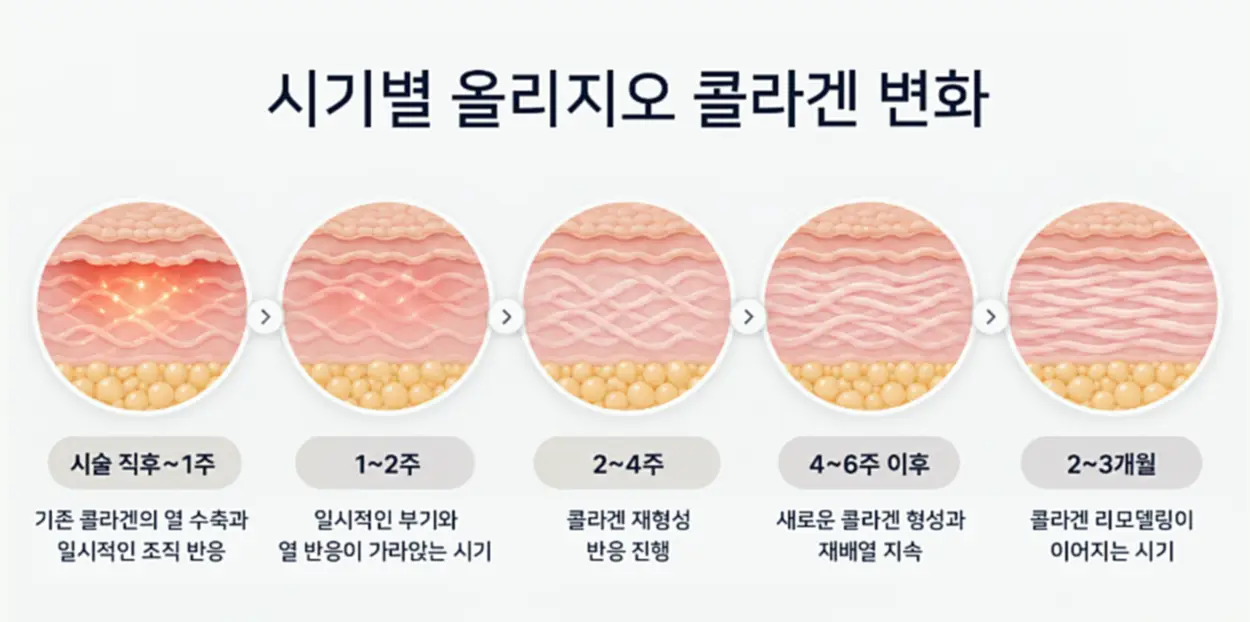 올리지오 시술 후 전후 효과가 나타나는 시기를 정리한 이미지