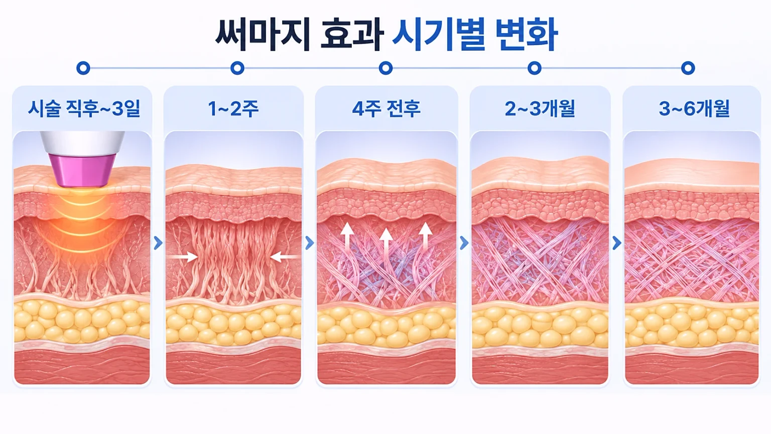 시술 직후부터 6개월까지 신생 콜라겐 생성량 변화를 시점별로 정리한 경과 흐름 이미지