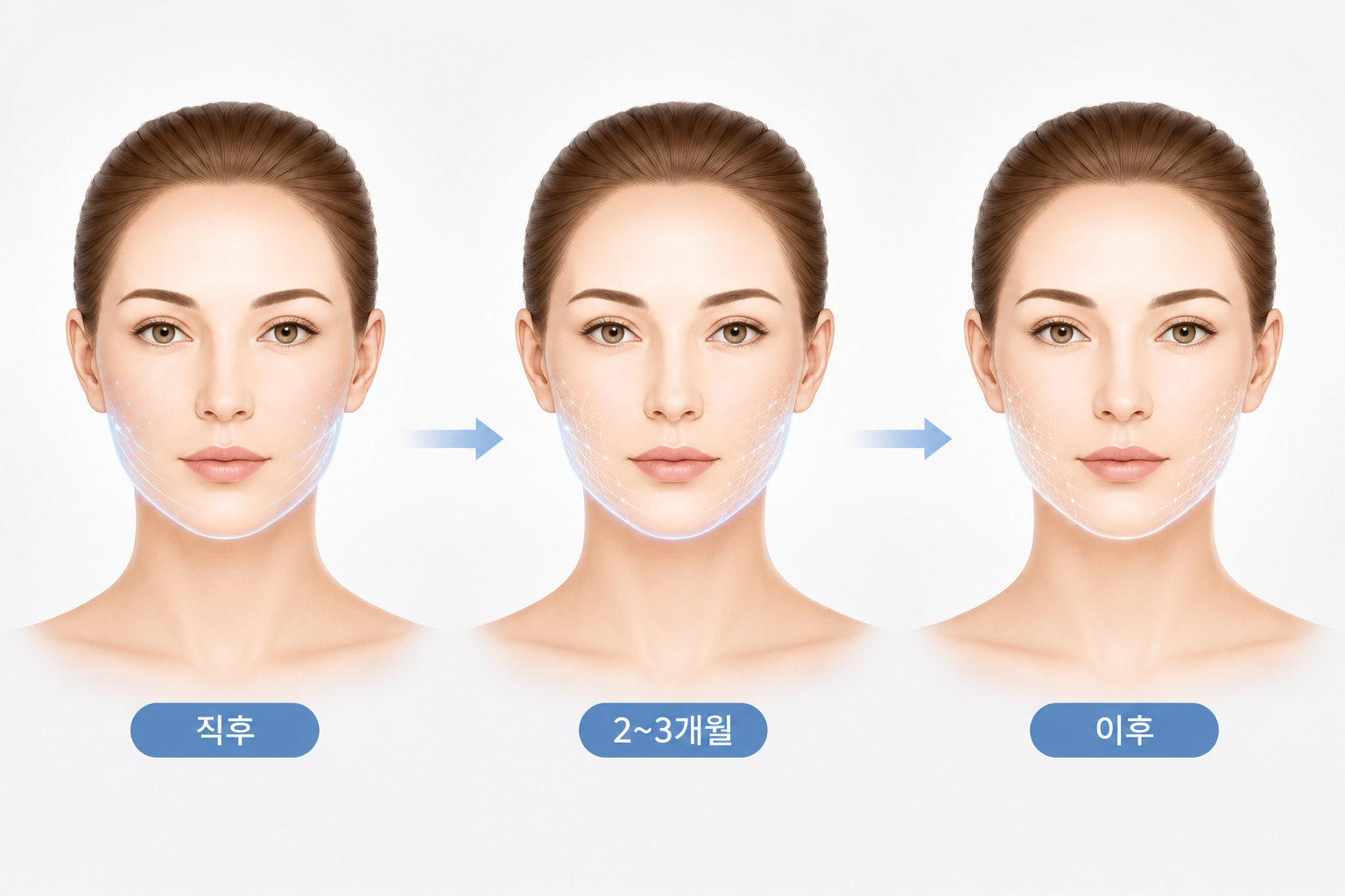 울쎄라 리프팅 후 시술 직후·2~3개월·이후 얼굴선 변화 과정