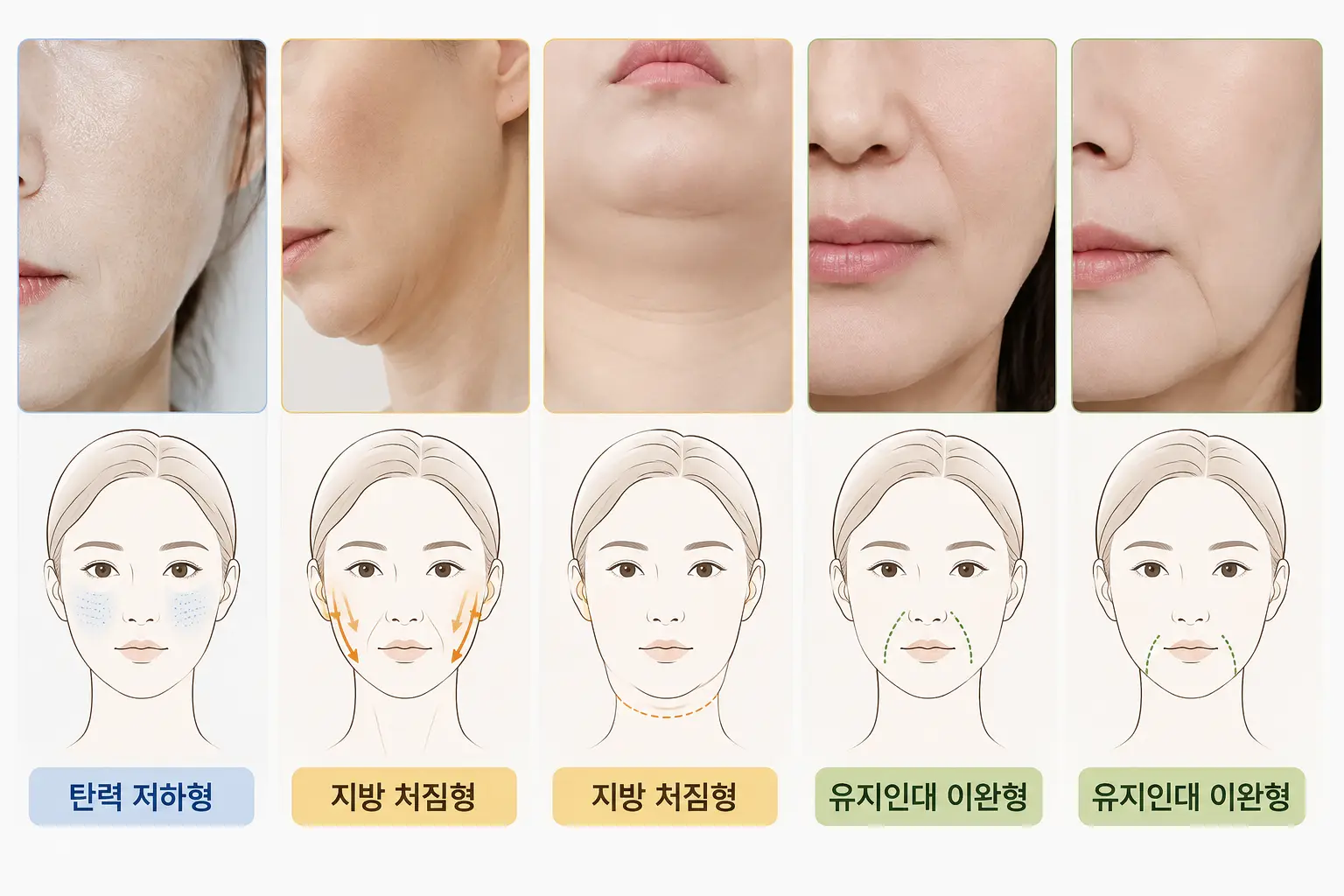 탄력 저하·지방 처짐·유지인대 이완으로 구분한 대구 리프팅 처짐 유형