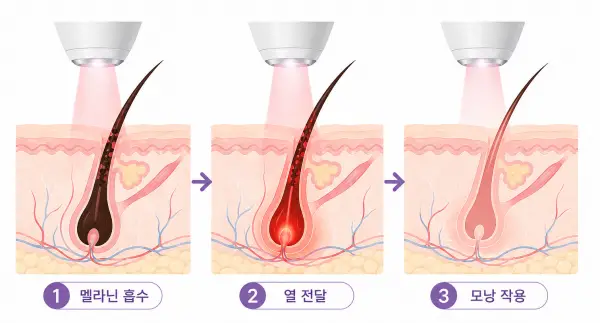 대전 레이저 제모 몇 회 필요할까 부위별 회차 기준 정리_유앤아이의원 대전점