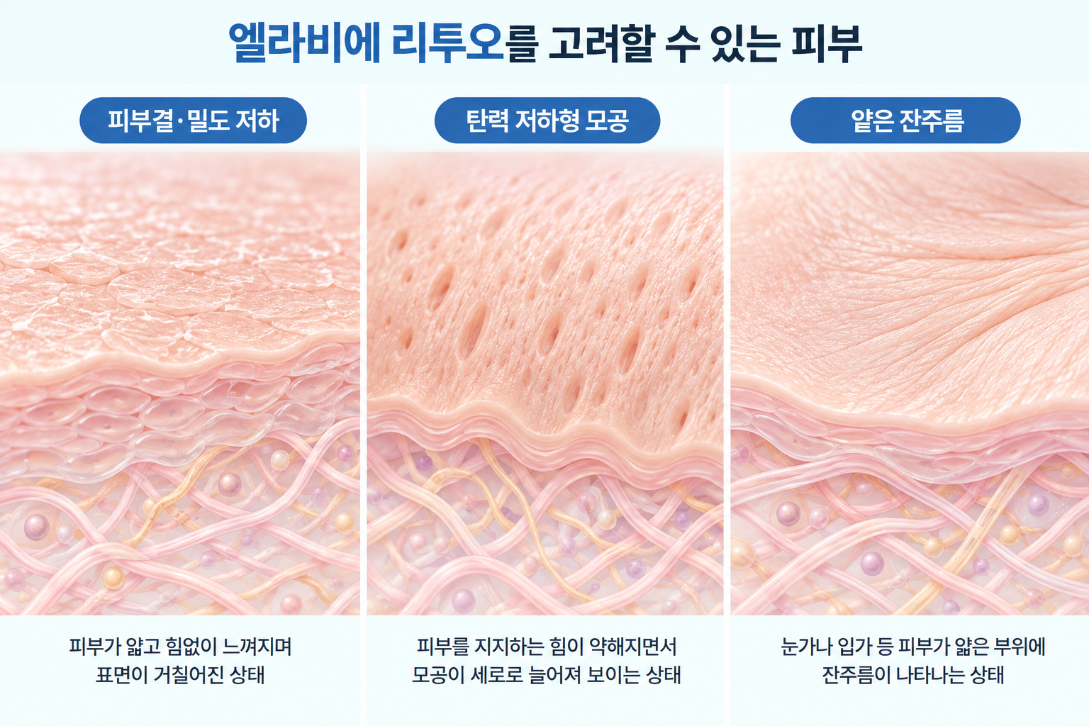 엘라비에 리투오를 고려할 수 있는 거친 피부결과 밀도 저하, 세로로 늘어진 모공, 얕은 잔주름의 피부 특징 비교
