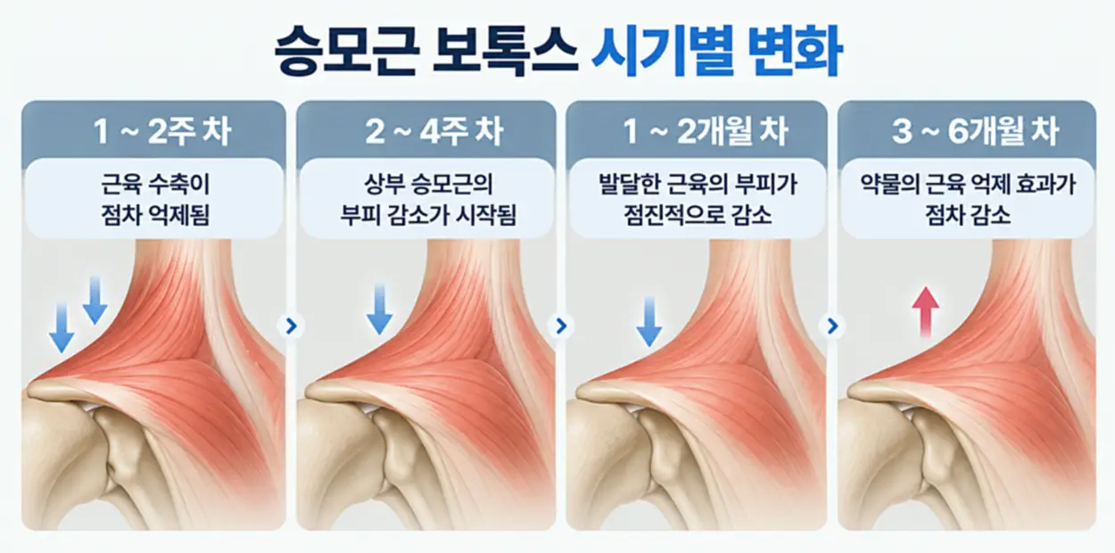승모근 보톡스 전후 1~2주, 2~4주, 1~2개월, 3~6개월에 따른 근육 수축 억제와 어깨 라인 변화 과정을 비교한 인포그래픽