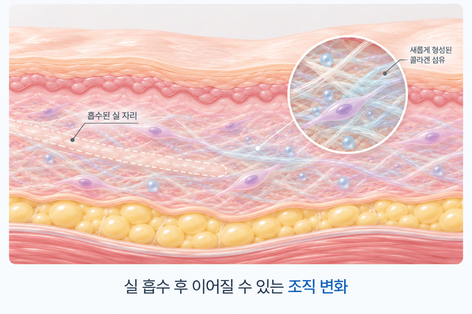 실 흡수 후 실 자리에 이어질 수 있는 콜라겐 조직 변화
