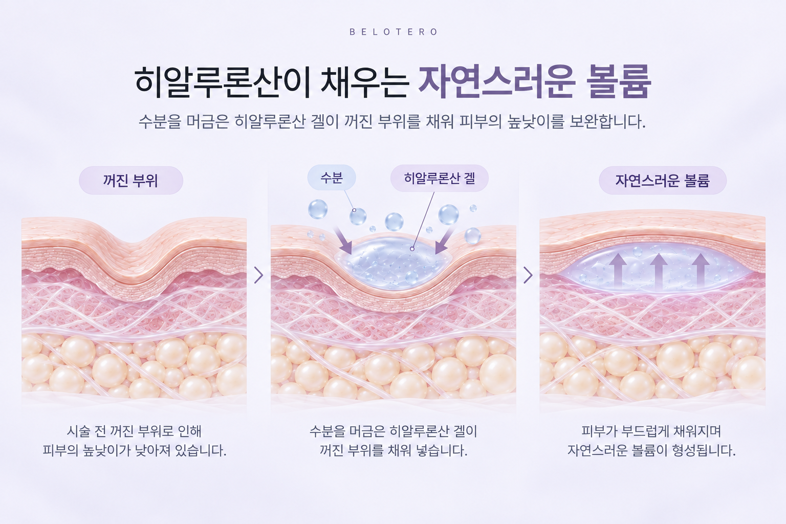 히알루론산 겔이 수분을 머금고 꺼진 부위의 볼륨을 보완하는 원리