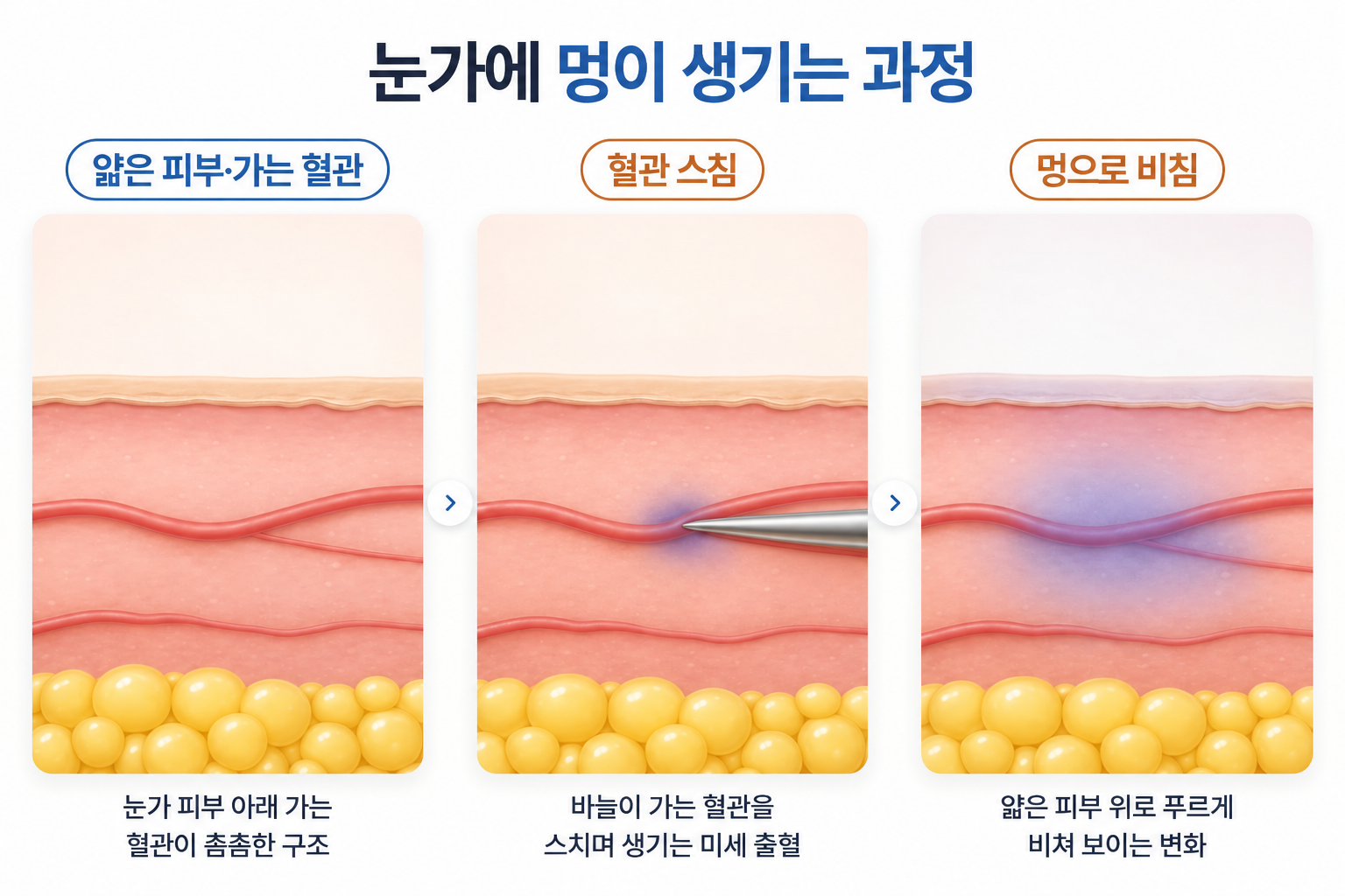 리쥬란 아이 주입 과정에서 눈가의 가는 혈관이 자극받아 미세출혈이 발생하고 멍으로 비치는 피부 구조