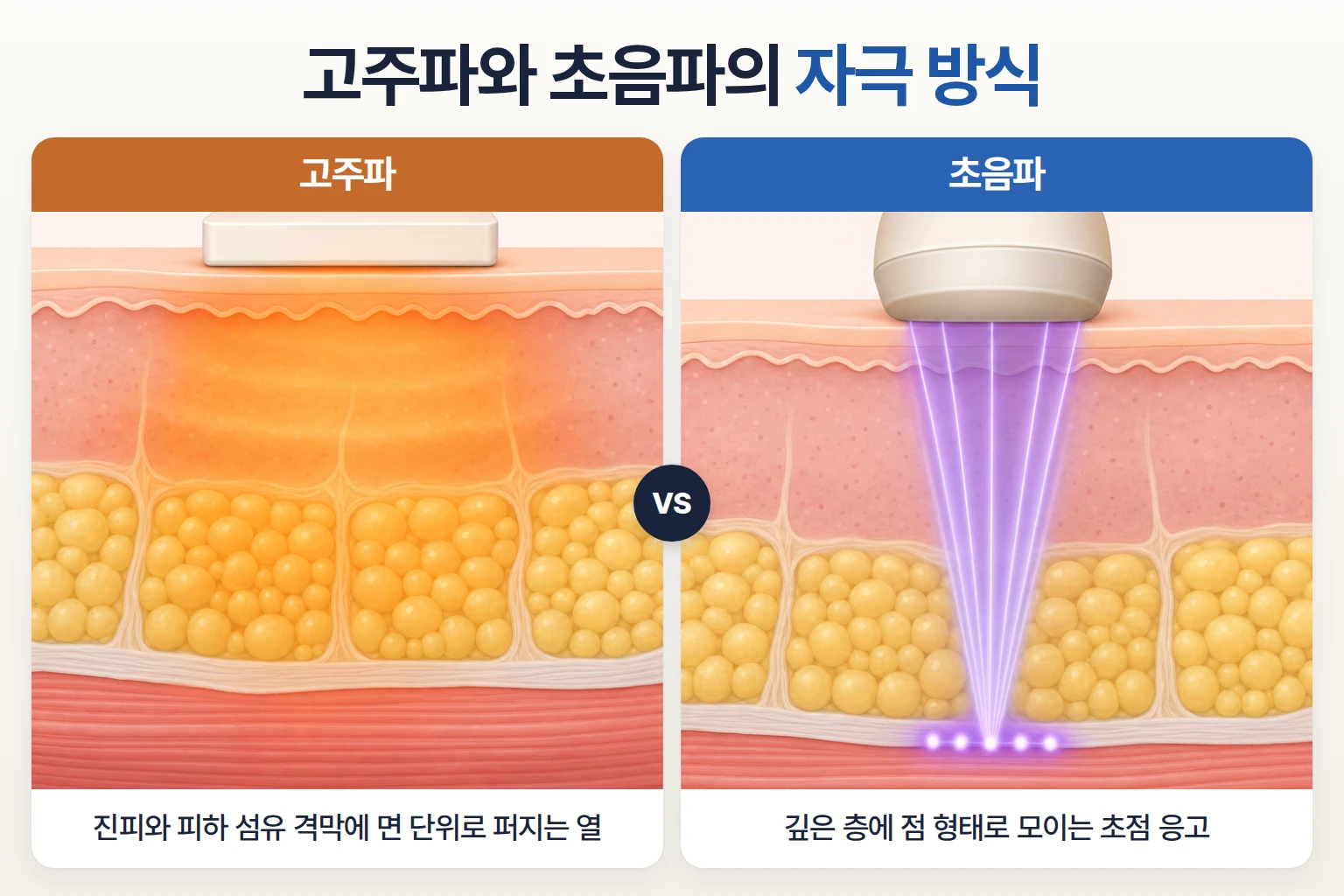 면 단위로 퍼지는 고주파 열과 점 단위로 모이는 초음파 초점을 비교한 단면도