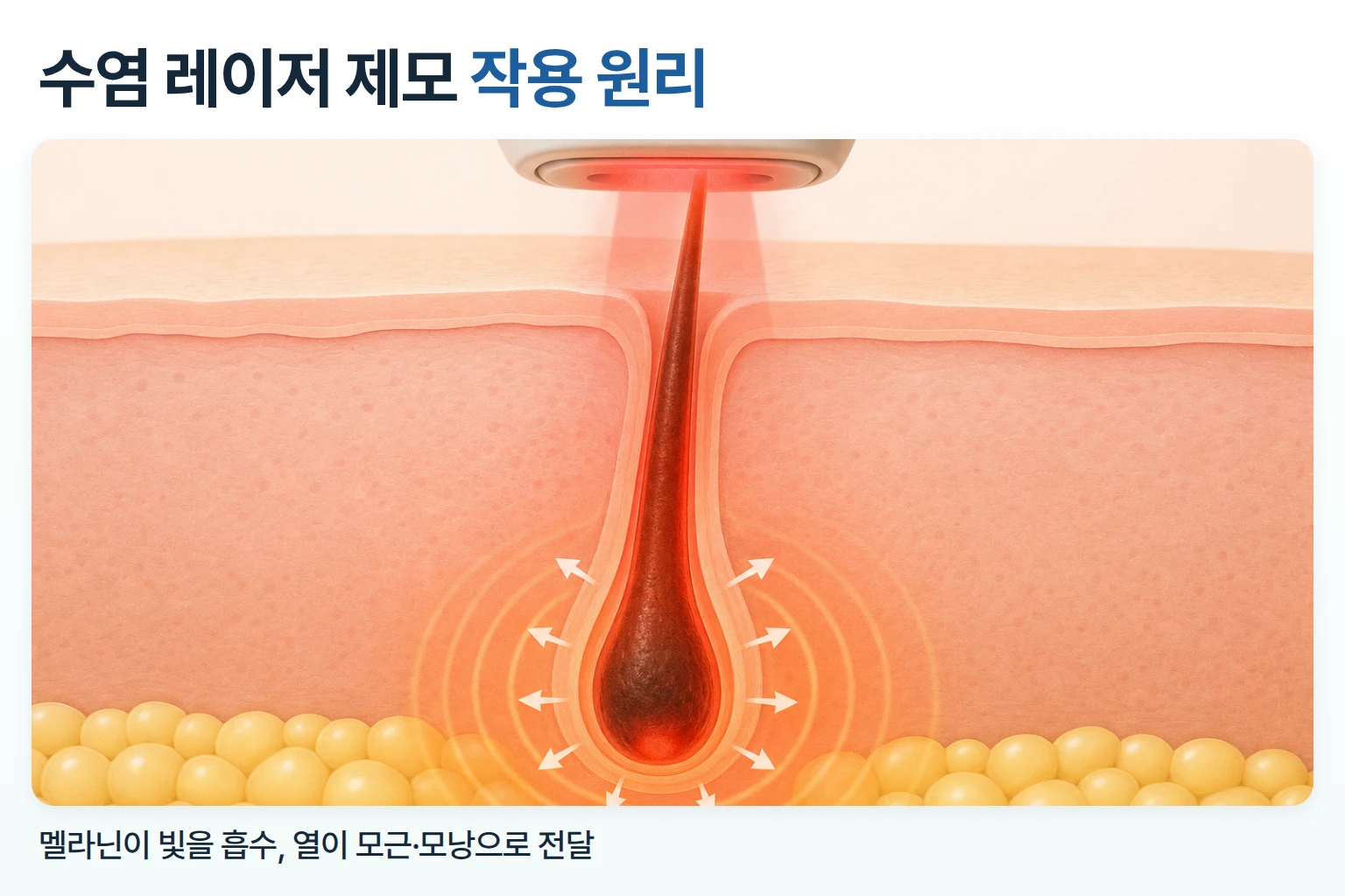 레이저 빛이 수염 속 멜라닌에 흡수되어 열이 모근과 모낭으로 퍼지는 과정을 그린 피부 단면도